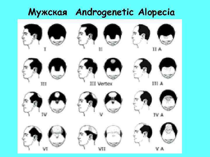 Мужская Androgenetic Alopecia 