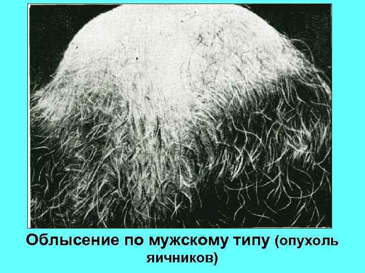 Облысение по мужскому типу (опухоль яичников) 