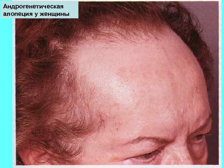Андрогенетическая алопеция у женщины 