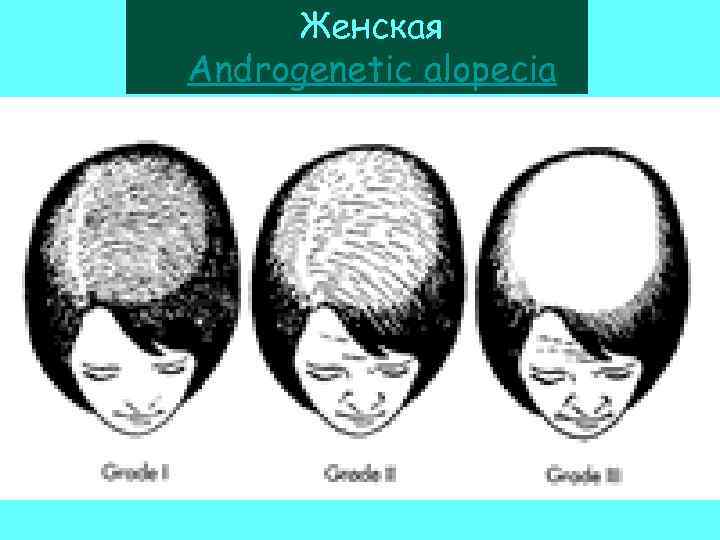 Женская Androgenetic аlopecia 