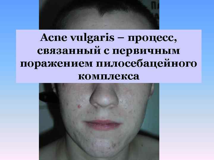 Acne vulgaris – процесс, связанный с первичным поражением пилосебацейного комплекса 