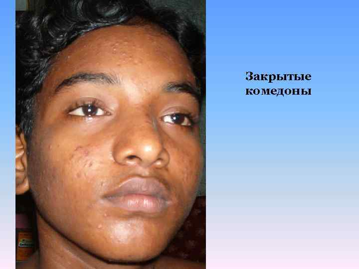 Закрытые комедоны 