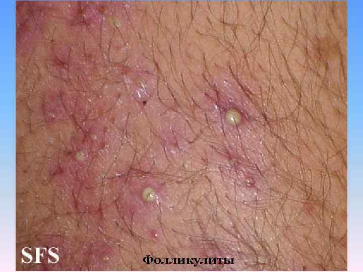Фолликулиты 