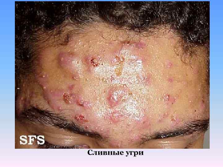 Сливные угри 