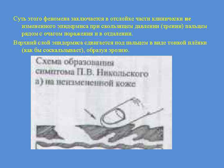 Суть этого феномена заключается в отслойке части клинически не измененного эпидермиса при скользящем давлении