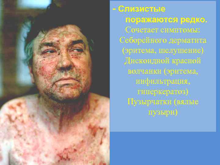 - Слизистые поражаются редко. Сочетает симптомы: Себорейного дерматита (эритема, шелушение) Дискоидной красной волчанки (эритема,