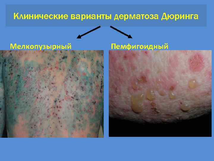 Клинические варианты дерматоза Дюринга Мелкопузырный Пемфигоидный 
