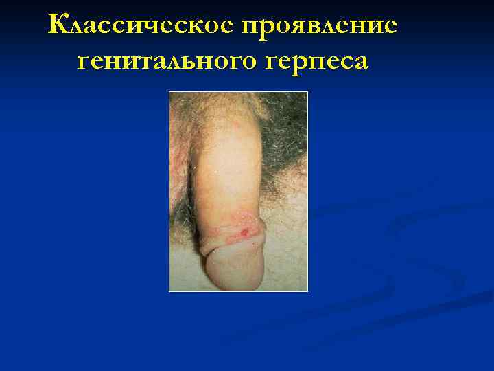 Классическое проявление генитального герпеса 