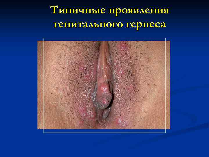 Типичные проявления генитального герпеса 