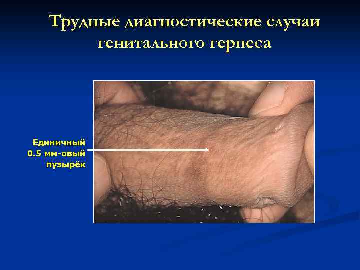 Трудные диагностические случаи генитального герпеса Единичный 0. 5 мм-овый пузырёк 