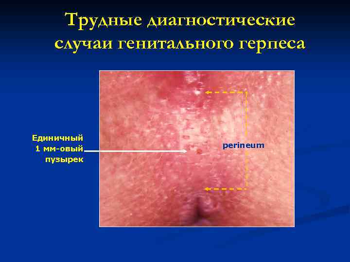 Трудные диагностические случаи генитального герпеса Единичный 1 мм-овый пузырек perineum 