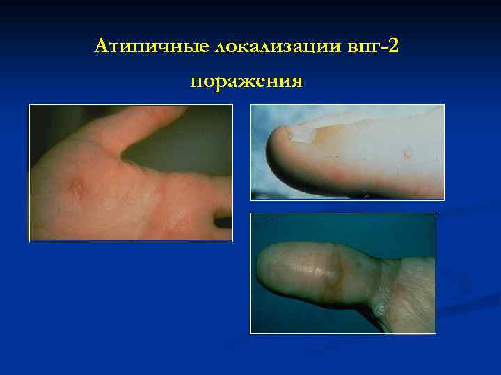 Атипичные локализации впг-2 поражения 
