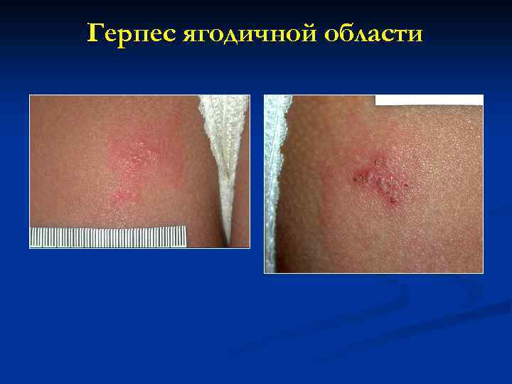 Герпес ягодичной области 