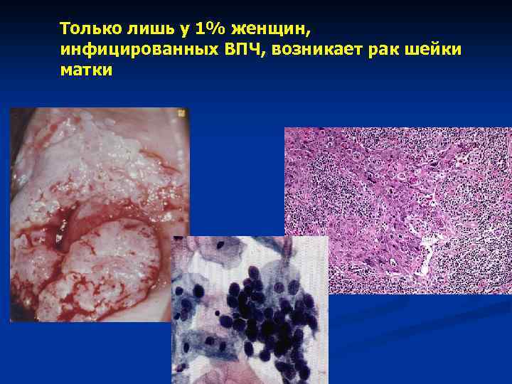 Только лишь у 1% женщин, инфицированных ВПЧ, возникает рак шейки матки 