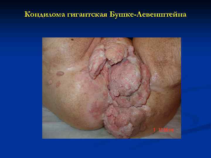 Кондилома гигантская Бушке-Левенштейна 