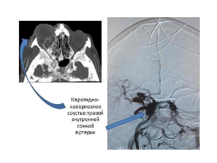 Соустье. Каротидно-кавернозного соустья. Каротидно-кавернозное соустье в офтальмологии. Каротидно-кавернозное соустье кт. Каротидно-кавернозное соустье мрт.