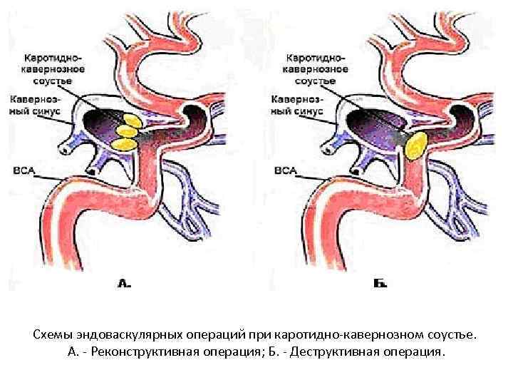 Операция бенталла де боно схема