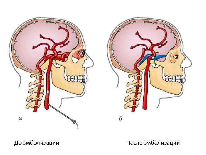 До эмболизации После эмболизации 