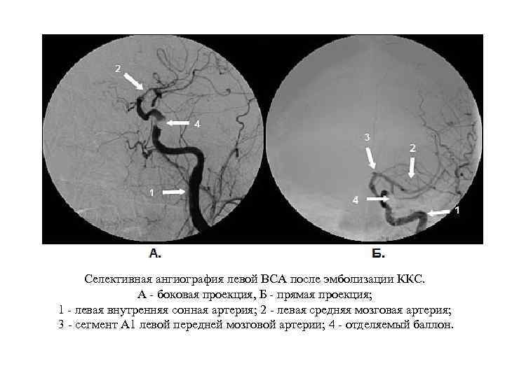 Селективная ангиография левой ВСА после эмболизации ККС. А - боковая проекция, Б - прямая