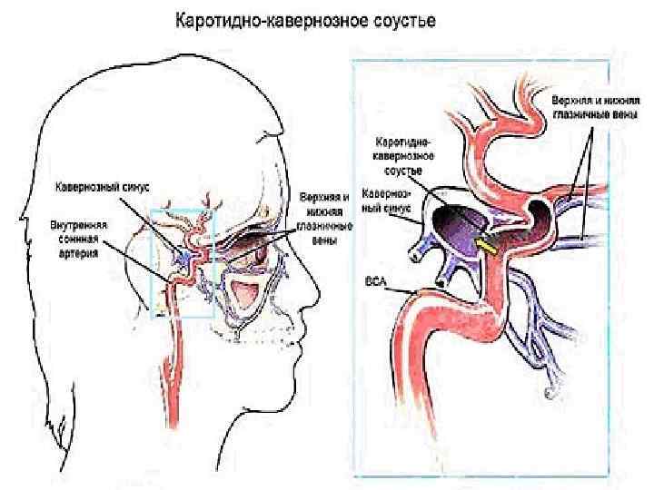 Соустье. Кавернозно каротидное соустье. Аневризма кавернозного синуса мрт. Артериовенозная аневризма в кавернозном синусе. Каротидно-кавернозное соустье в офтальмологии.