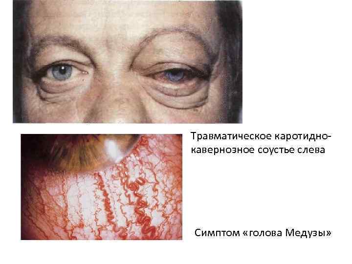 Травматическое каротиднокавернозное соустье слева Симптом «голова Медузы» 
