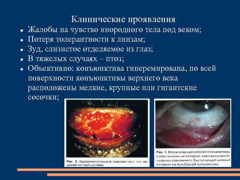 Клинические проявления Жалобы на чувство инородного тела под веком; Потеря толерантности к линзам; Зуд,