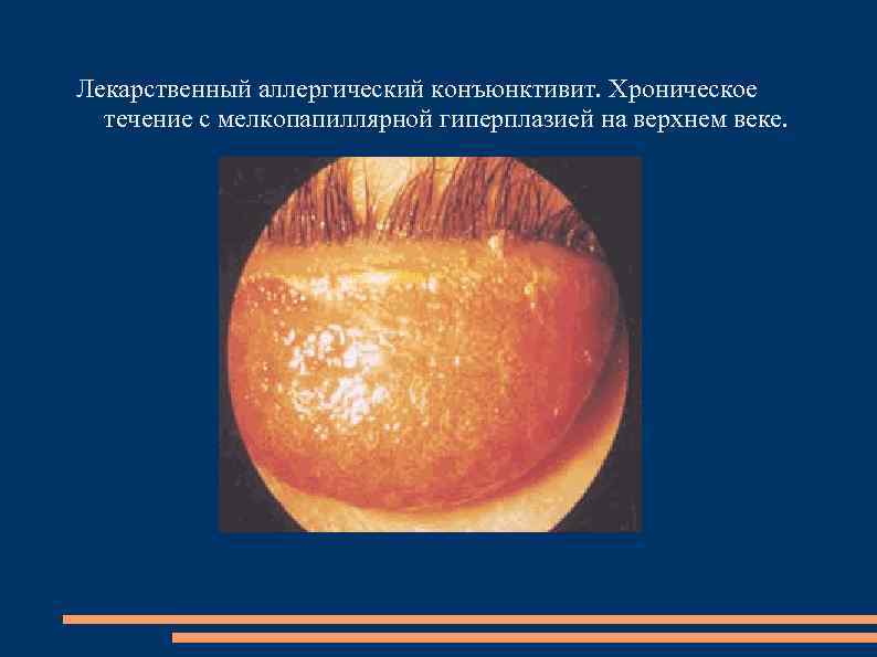 Лекарственный аллергический конъюнктивит. Хроническое течение с мелкопапиллярной гиперплазией на верхнем веке. 