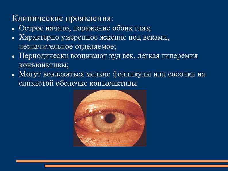 Клинические проявления: Острое начало, поражение обоих глаз; Характерно умеренное жжение под веками, незначительное отделяемое;