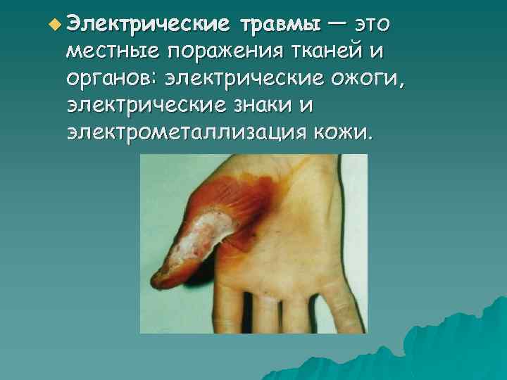 u Электрические травмы — это местные поражения тканей и органов: электрические ожоги, электрические знаки