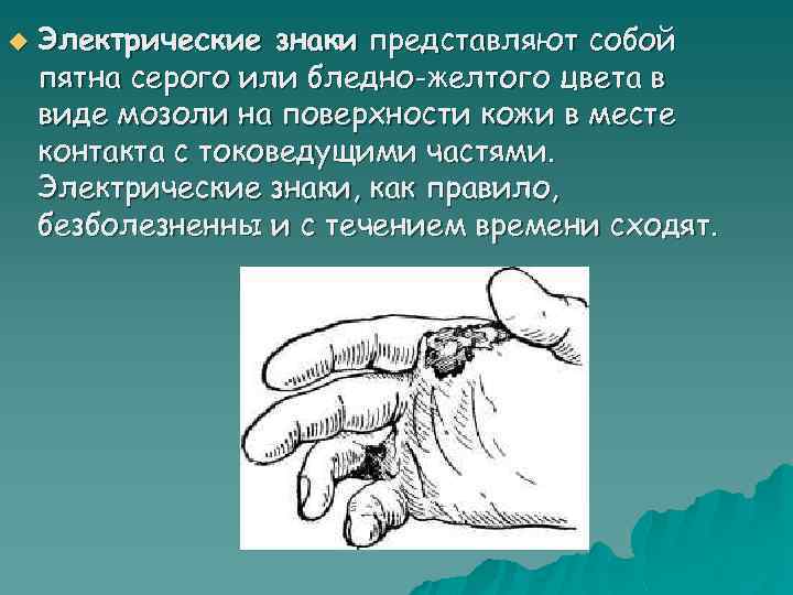 u Электрические знаки представляют собой пятна серого или бледно-желтого цвета в виде мозоли на