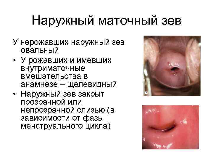 Наружный маточный зев У нерожавших наружный зев овальный • У рожавших и имевших внутриматочные