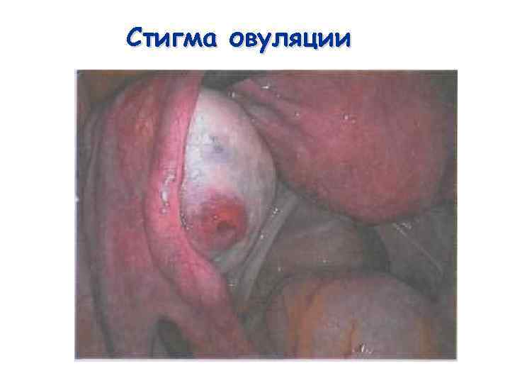 Стигма овуляции 