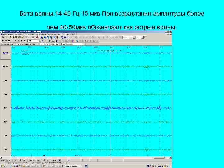 Бета волны. 14 -40 Гц 15 мкв При возрастании амплитуды более чем 40 -50