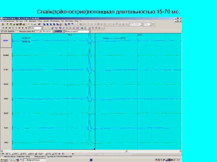 Спайк(spike-острие)потенциал длительностью 15 -70 мс. 