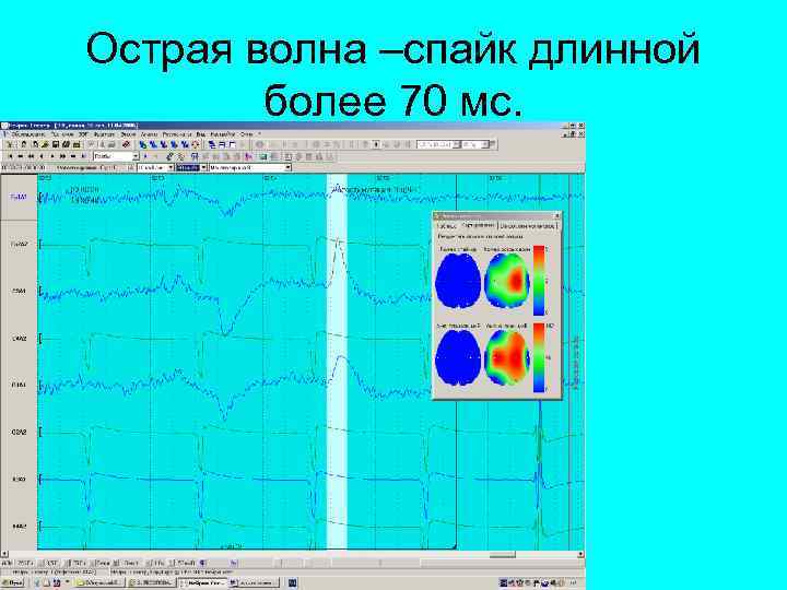 Острая волна –спайк длинной более 70 мс. 