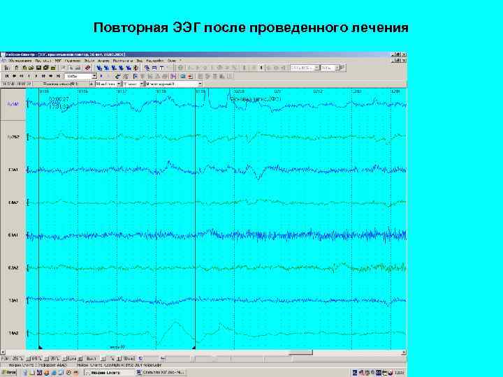 Повторная ЭЭГ после проведенного лечения 