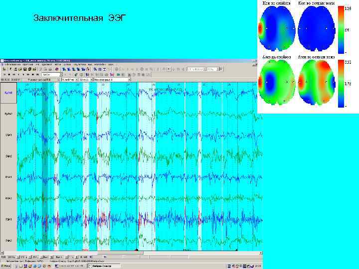 Заключительная ЭЭГ 