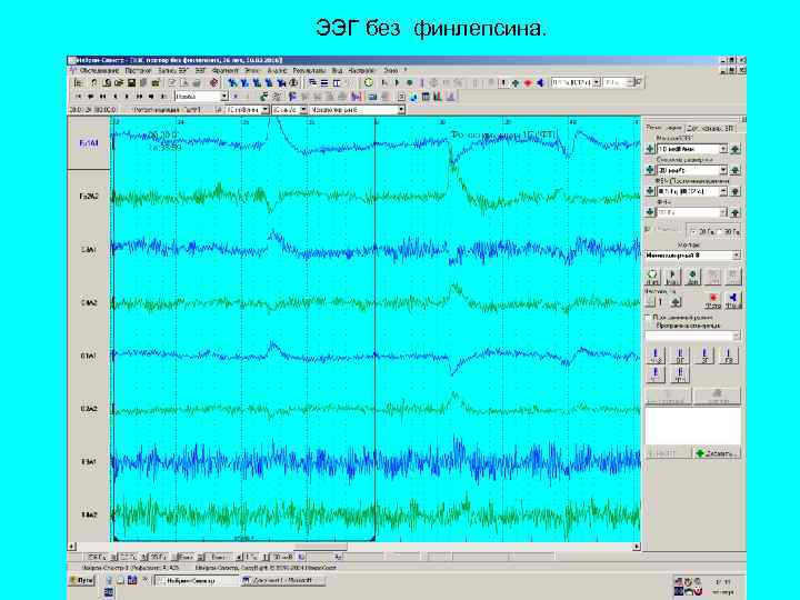ЭЭГ без финлепсина. 