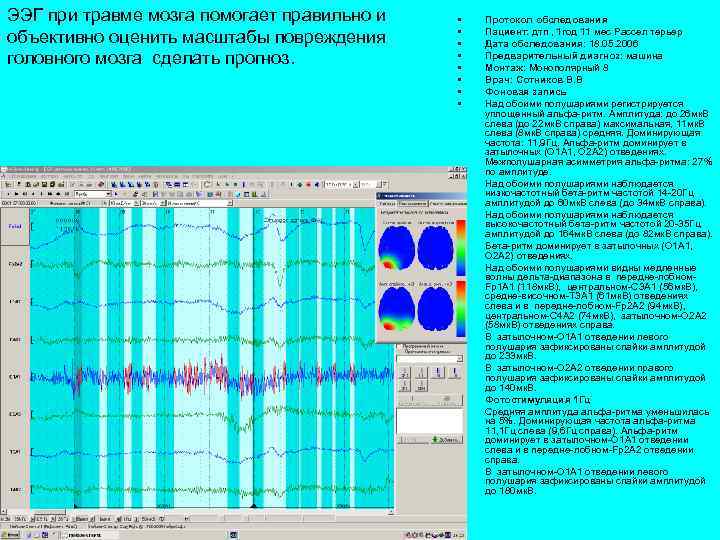 ЭЭГ при травме мозга помогает правильно и объективно оценить масштабы повреждения головного мозга сделать