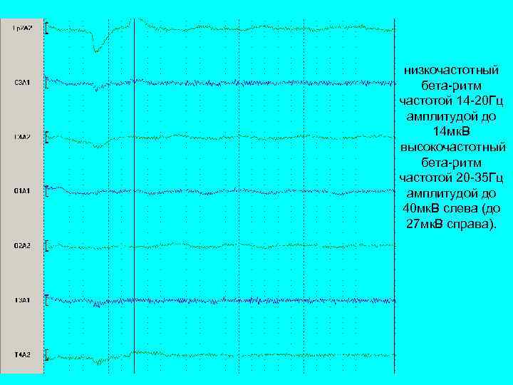 низкочастотный бета-ритм частотой 14 -20 Гц амплитудой до 14 мк. В высокочастотный бета-ритм частотой