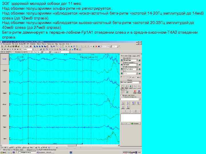 ЭЭГ здоровой молодой собаки дог 11 мес. Над обоими полушариями альфа-ритм не pегистpиpуется. .
