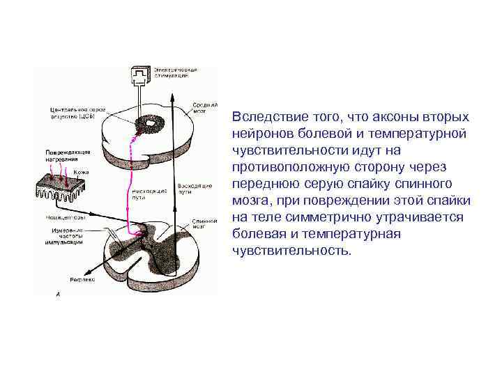 Вследствие того, что аксоны вторых нейронов болевой и температурной чувствительности идут на противоположную сторону