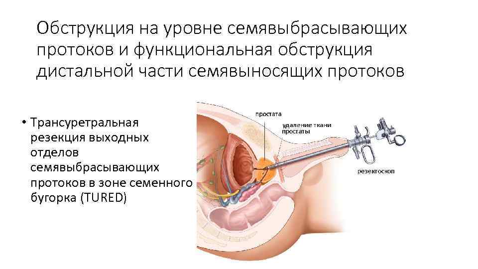 Обструкция на уровне семявыбрасывающих протоков и функциональная обструкция дистальной части семявыносящих протоков • Трансуретральная