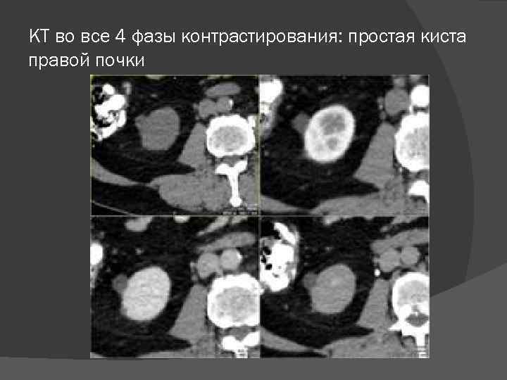 КТ во все 4 фазы контрастирования: простая киста правой почки 