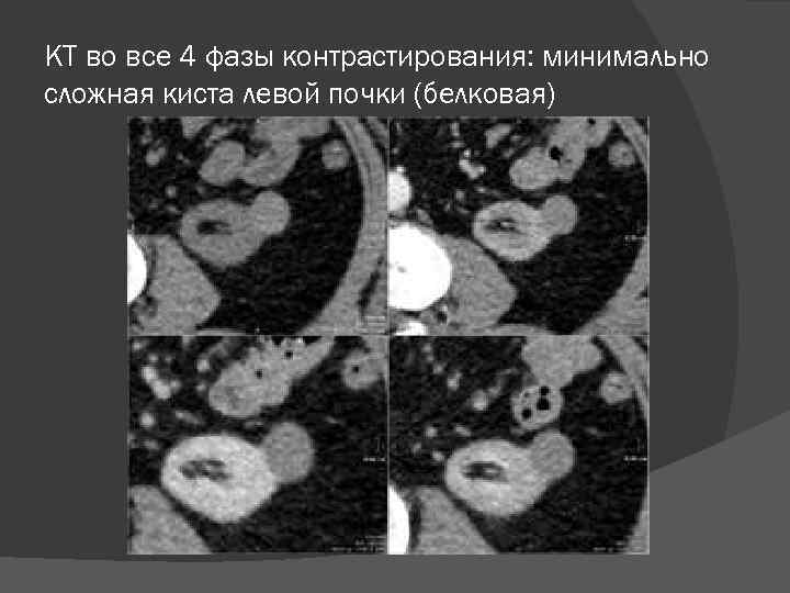 КТ во все 4 фазы контрастирования: минимально сложная киста левой почки (белковая) 