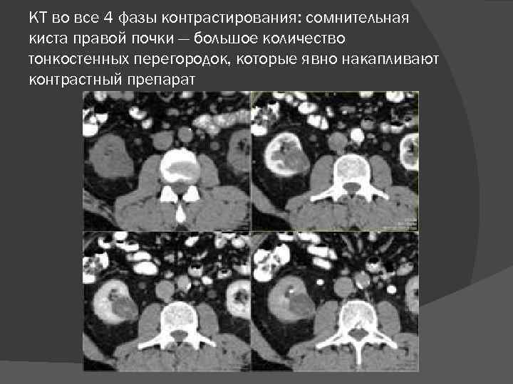 КТ во все 4 фазы контрастирования: сомнительная киста правой почки — большое количество тонкостенных