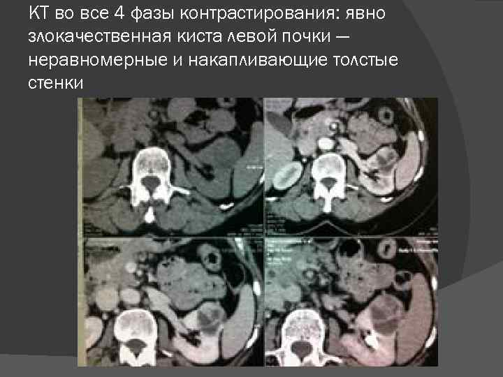 КТ во все 4 фазы контрастирования: явно злокачественная киста левой почки — неравномерные и