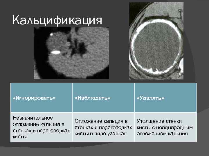 Кальцификация «Игнорировать» «Наблюдать» «Удалять» Незначительное Отложение кальция в Утолщение стенки отложение кальция в стенках