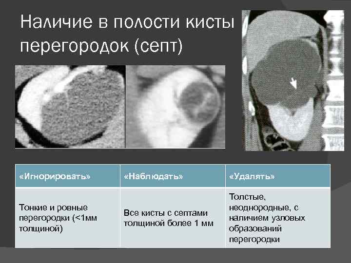 Наличие в полости кисты перегородок (септ) «Игнорировать» Тонкие и ровные перегородки (<1 мм толщиной)