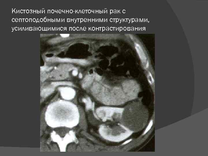 Кистозный почечно-клеточный рак с септоподобными внутренними структурами, усиливающимися после контрастирования 